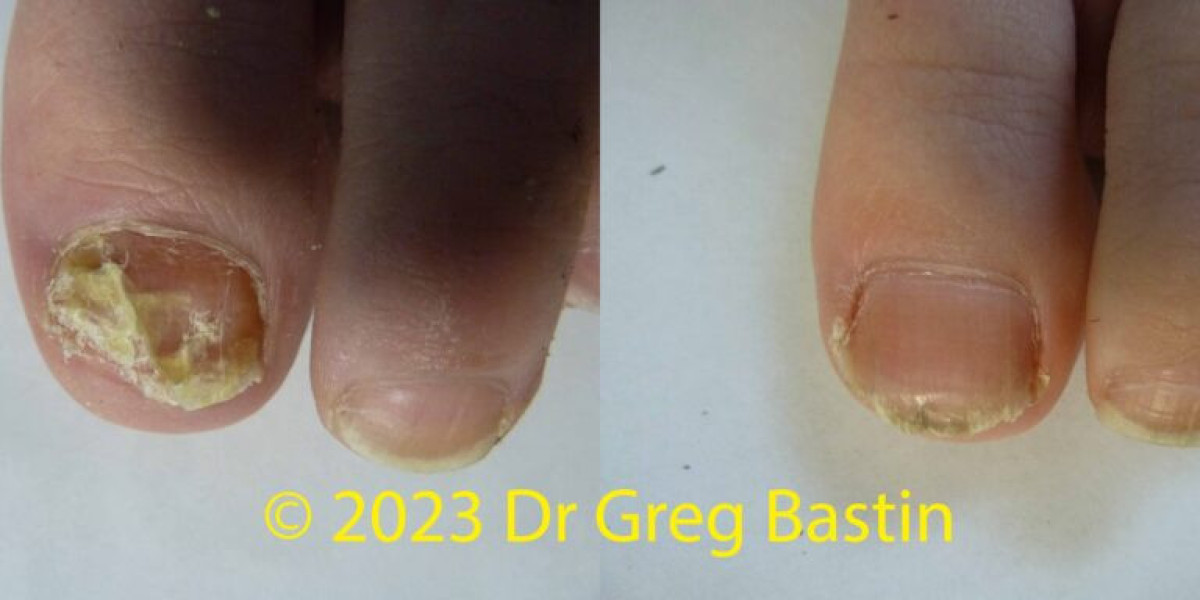 Unleashing the Power of Lunula Laser Treatment for Onychomycosis