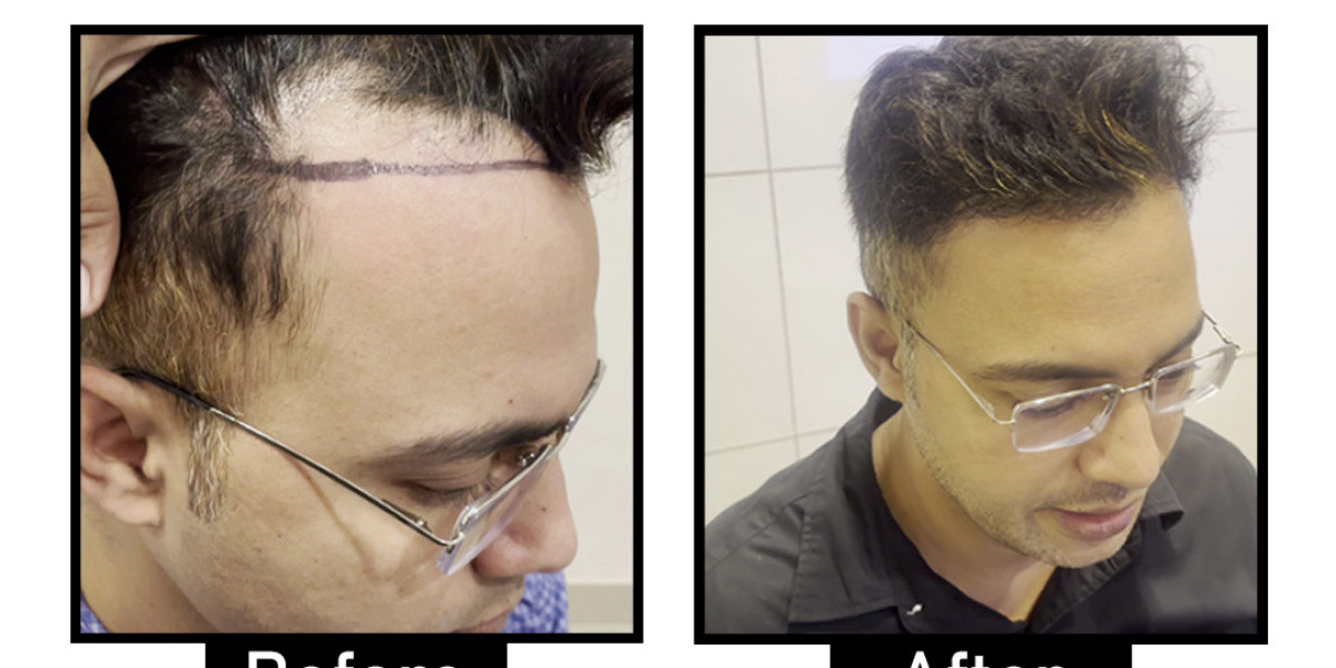 Best Hair Transplant Techniques in Delhi NCR for Natural Results